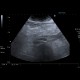 Mesenterial lipodystrophy on ultrasound: US - Ultrasound